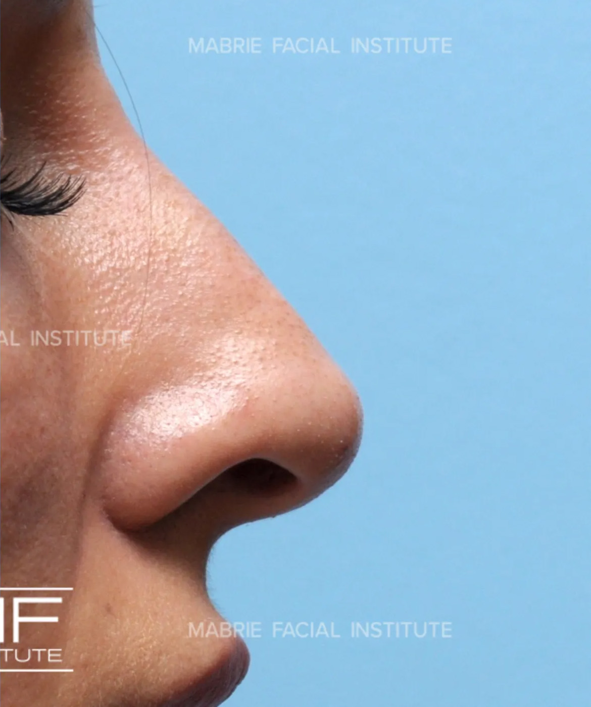 woman's nose after nonsurgical rhinoplasty