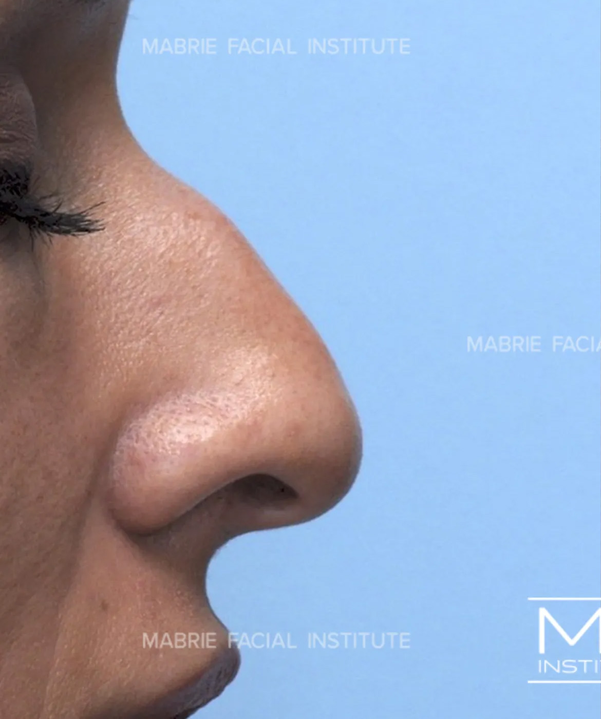 woman's nose before nonsurgical rhinoplasty