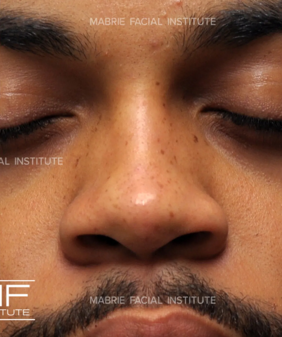 male after nonsurgical rhinoplasty