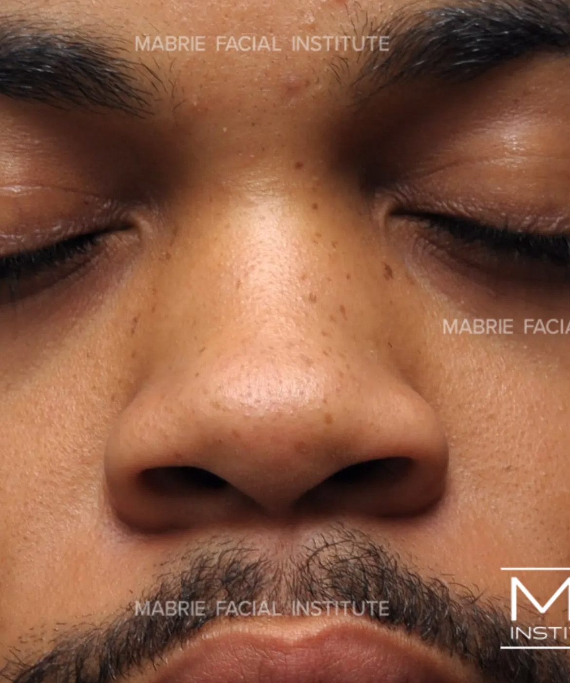 male before nonsurgical rhinoplasty