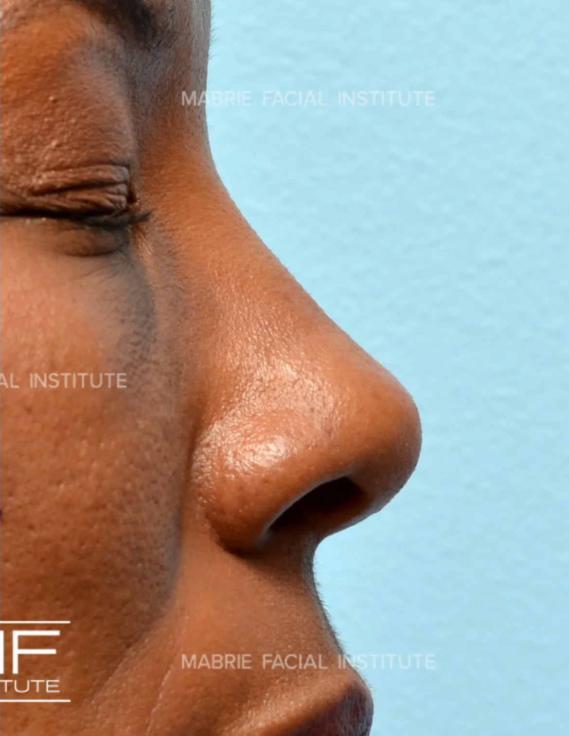 sideview of woman's nose after nonsurgical rhinoplasty