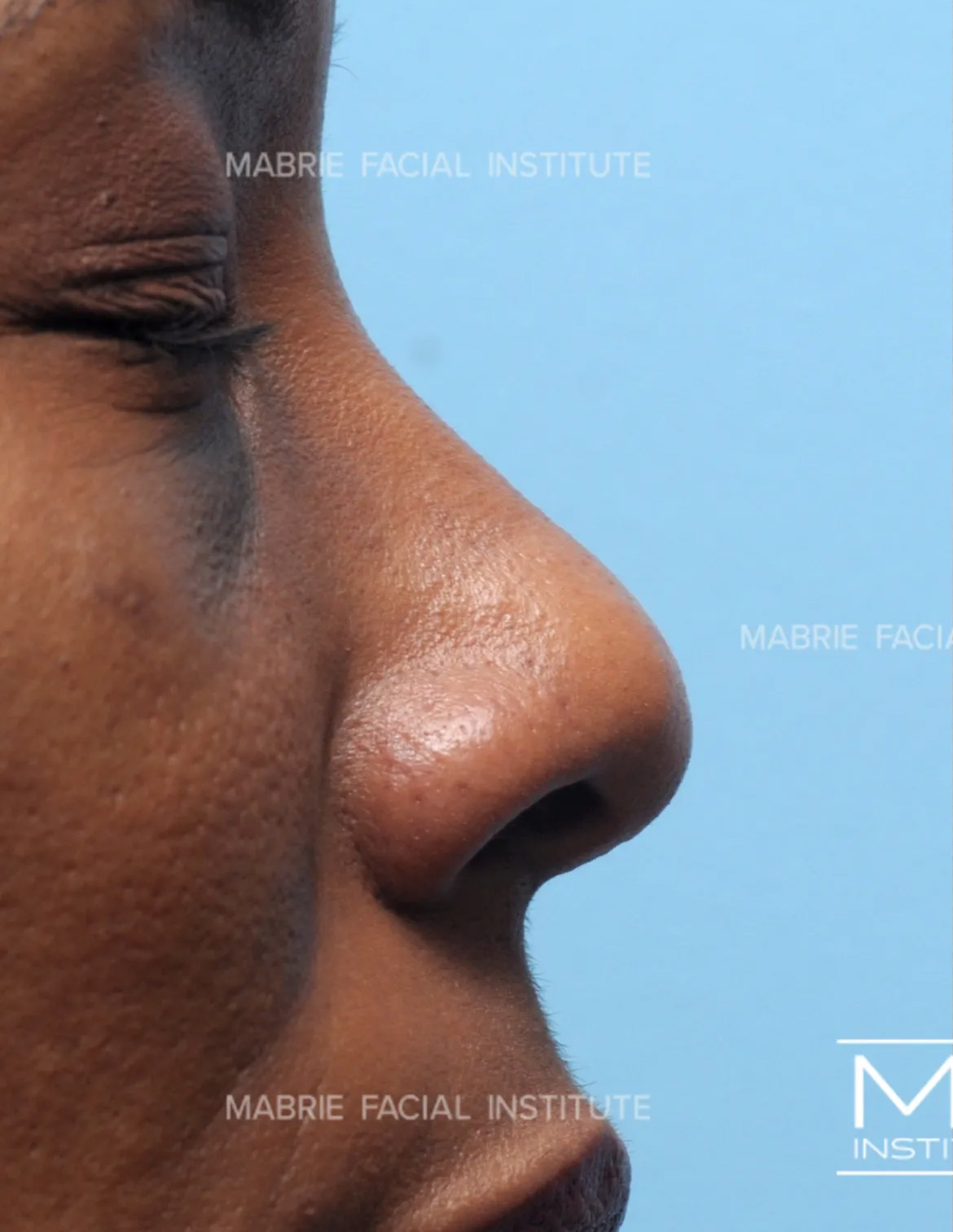 sideview of woman's nose before nonsurgical rhinoplasty