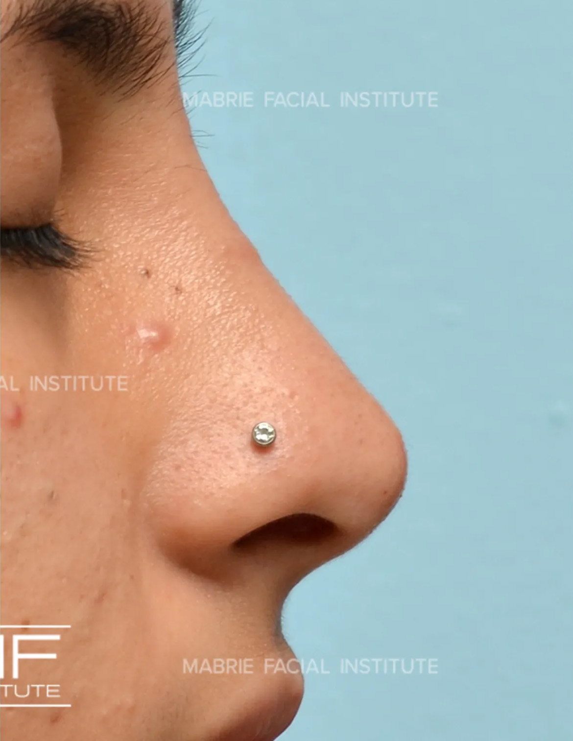 sideview of woman's nose after nonsurgical rhinoplasty