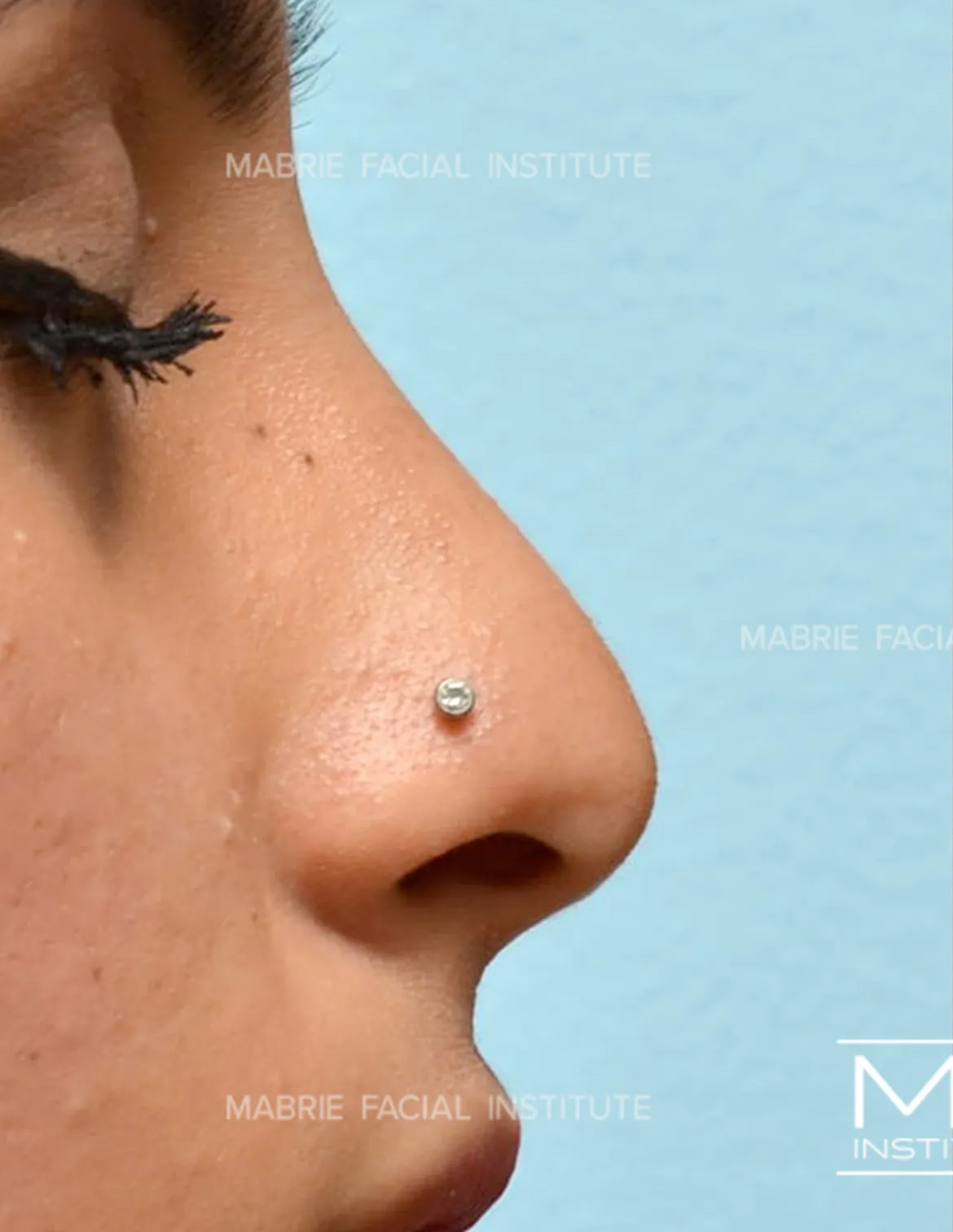 sideview of woman's nose before nonsurgical rhinoplasty