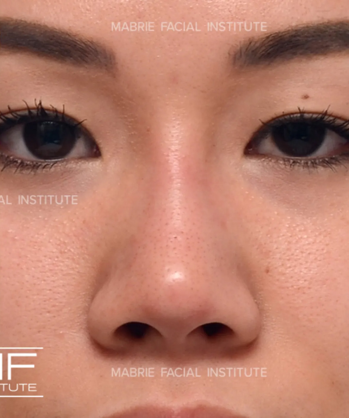 Nonsurgical Rhinoplasty - Augmenting the Bridge - After