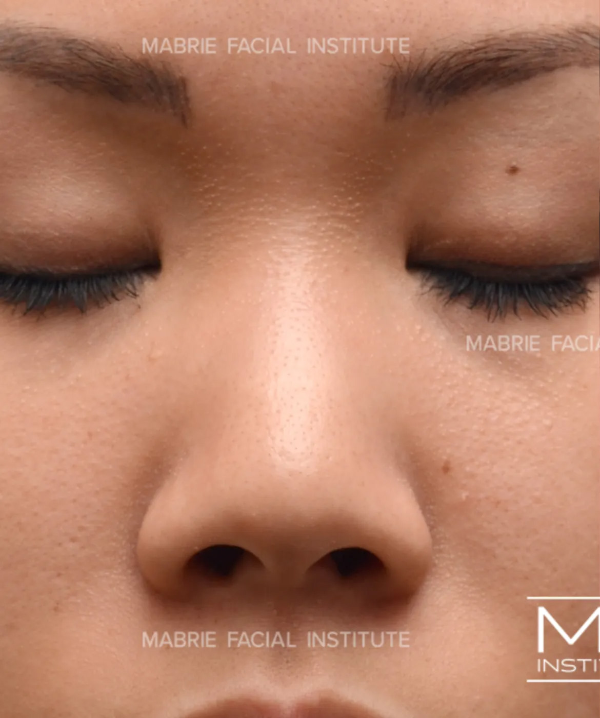 Nonsurgical Rhinoplasty - Augmenting the Bridge - Before