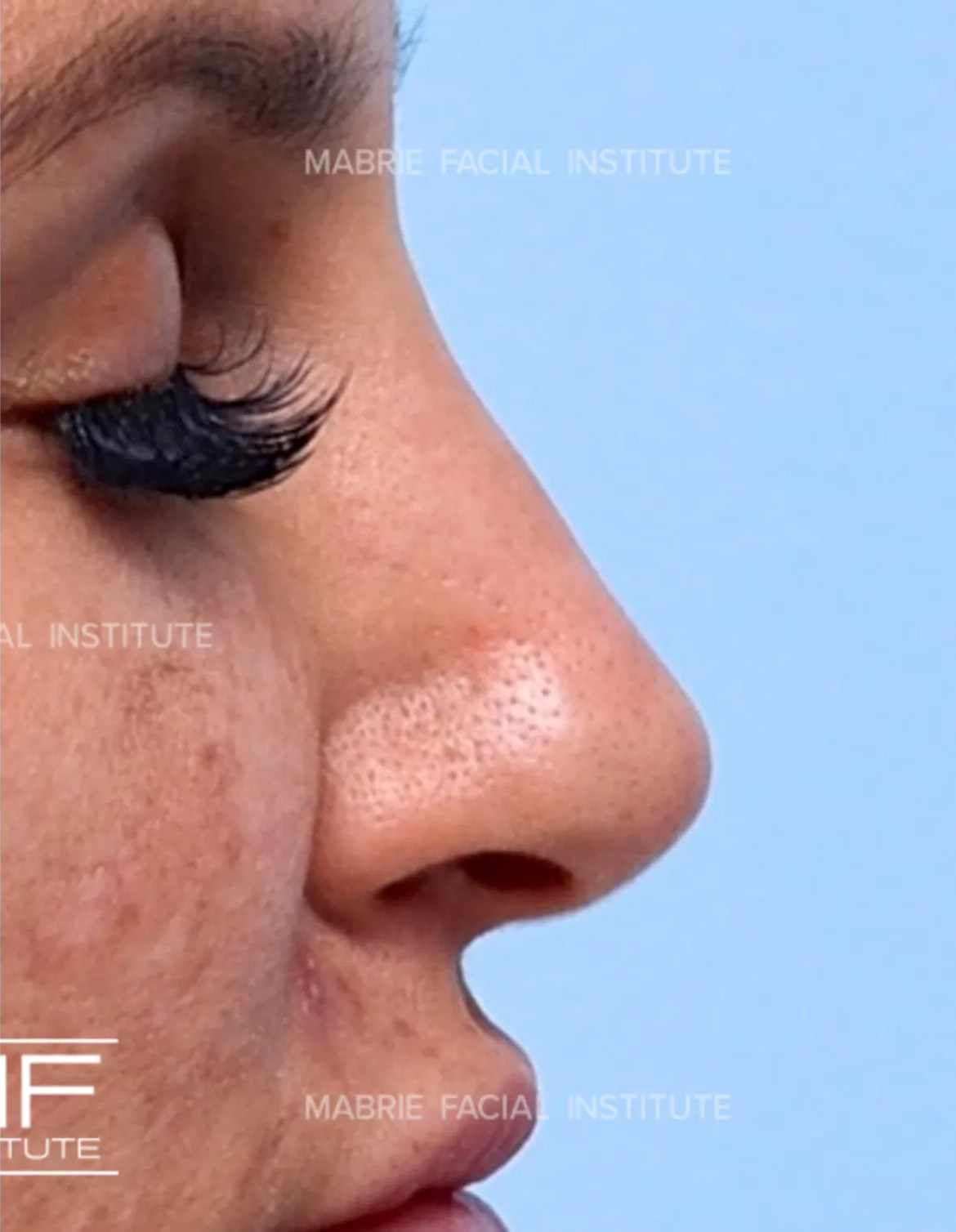 sideview of woman's nose after nonsurgical rhinoplasty