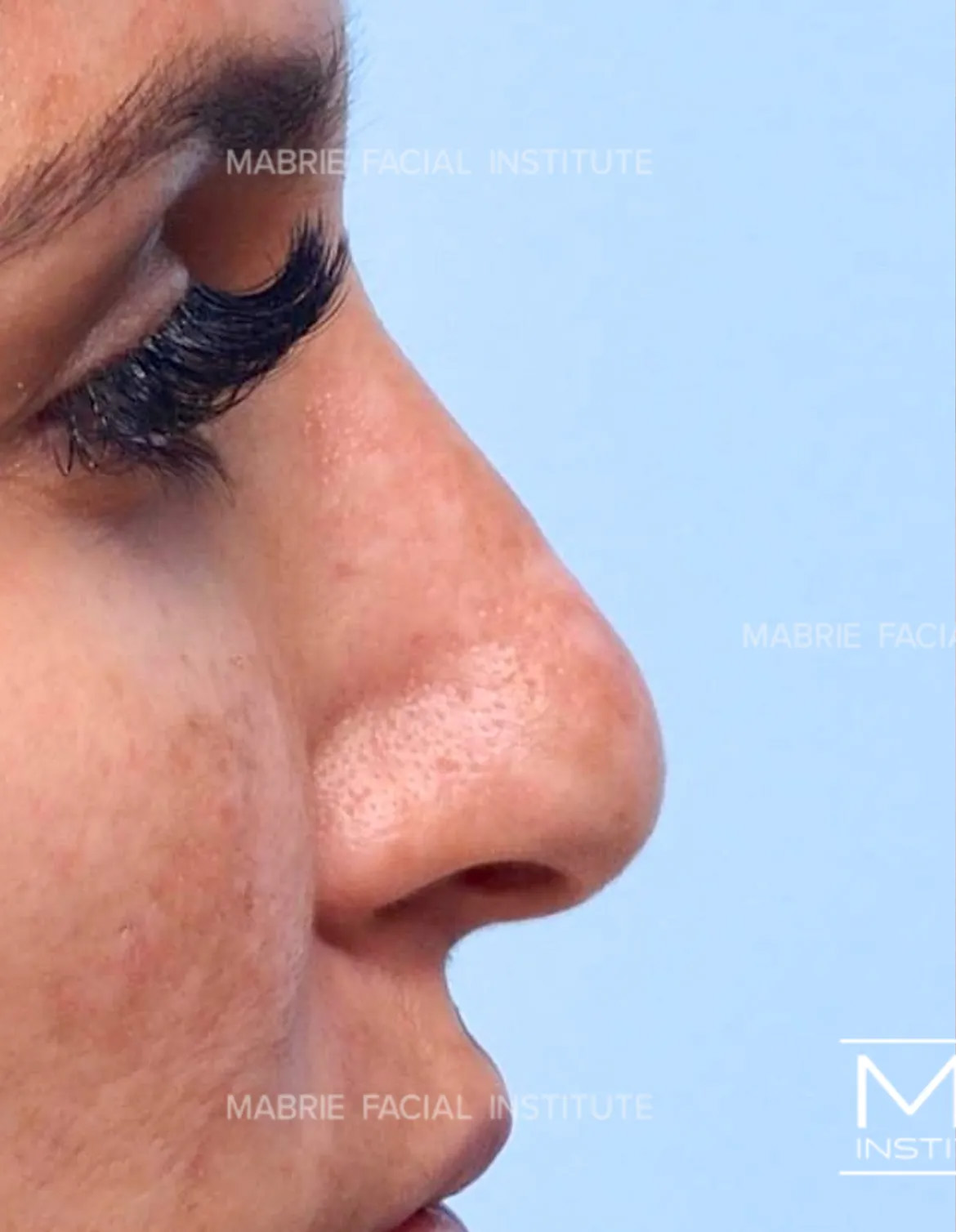 sideview of woman's nose before nonsurgical rhinoplasty