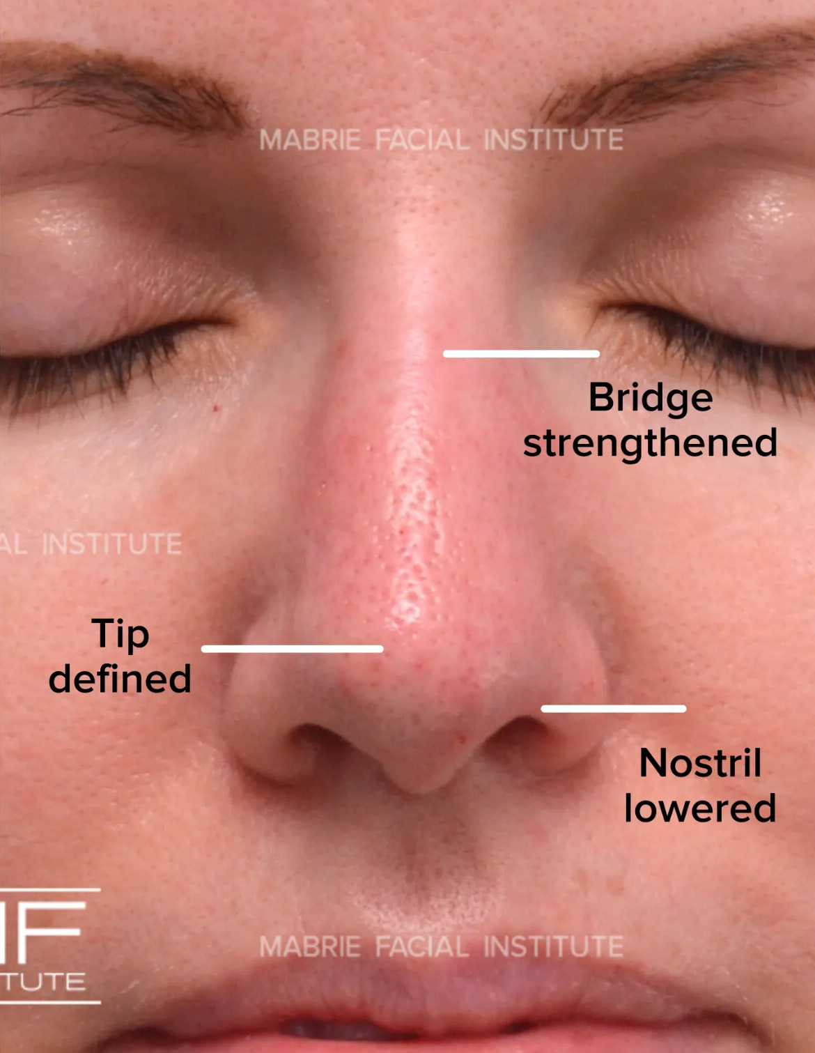 woman after nonsurgical rhinoplasty