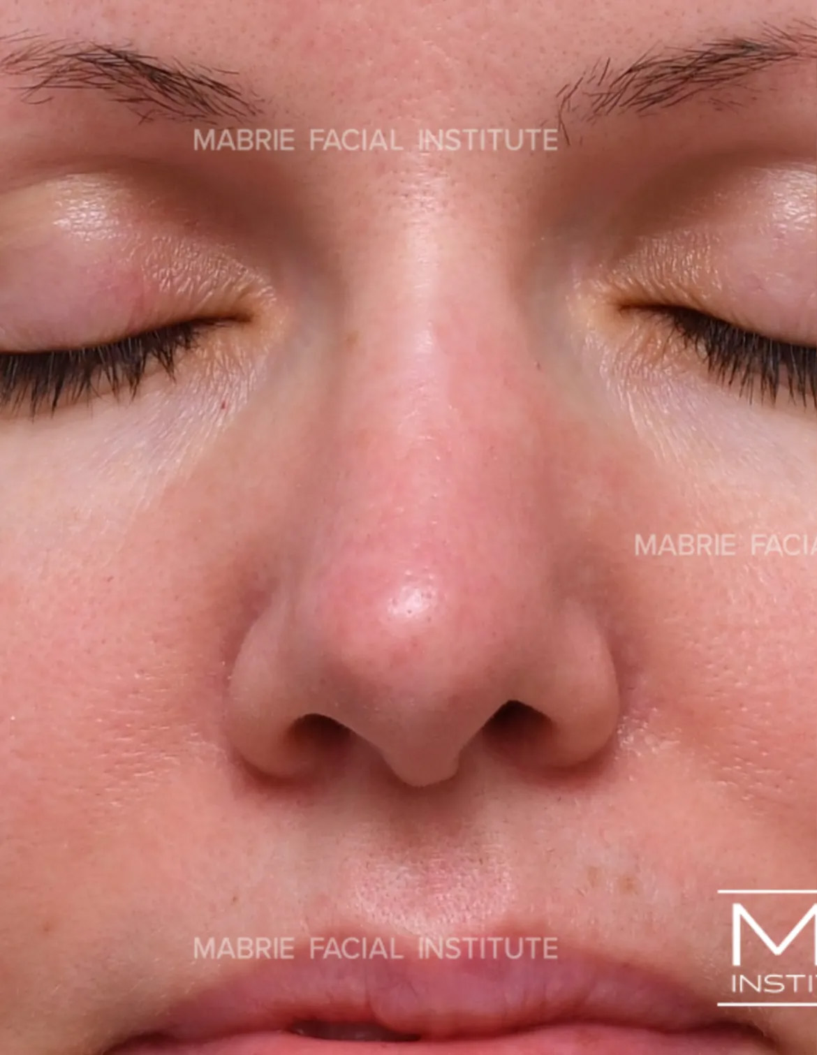 woman before nonsurgical rhinoplasty