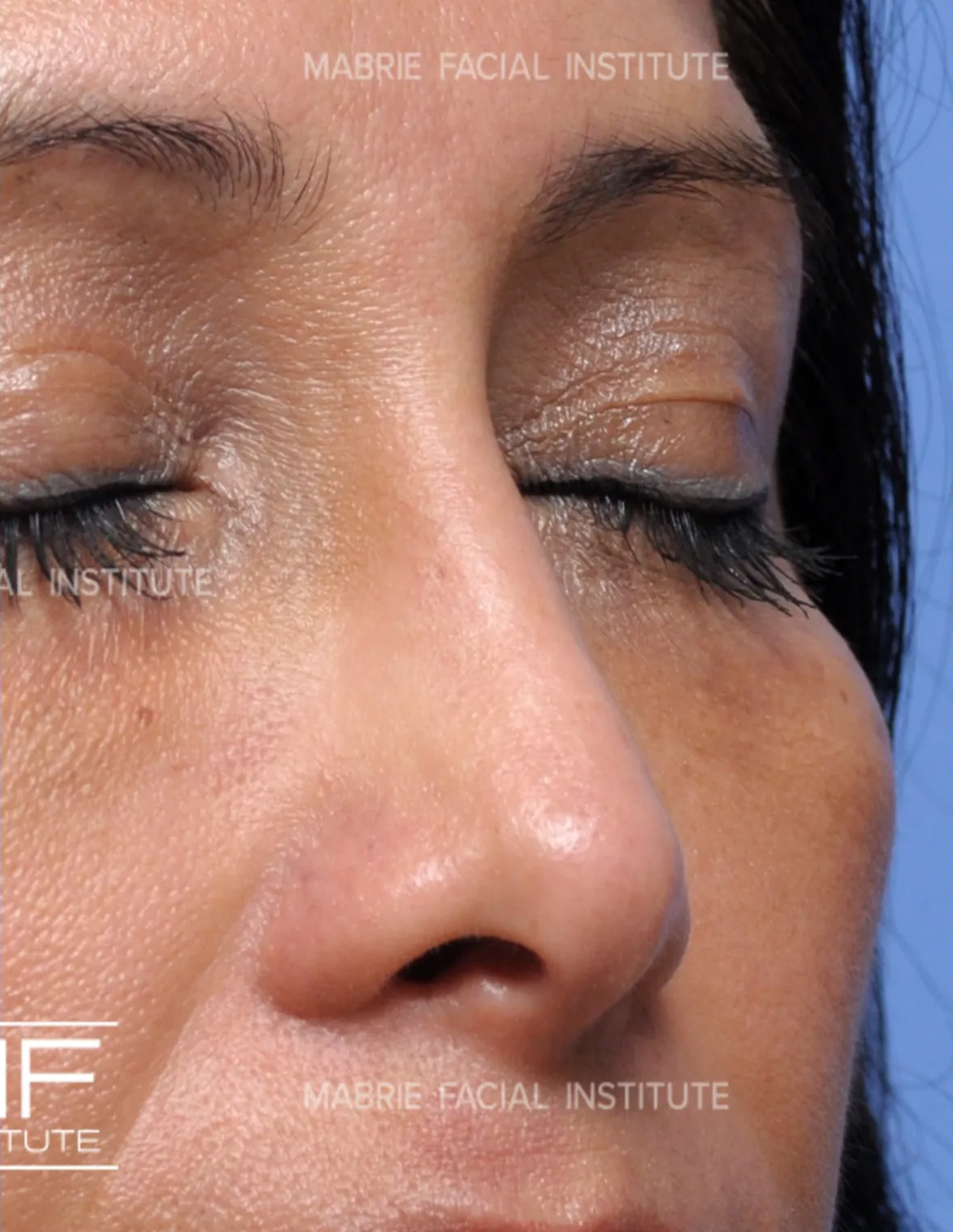 woman after nonsurgical rhinoplasty