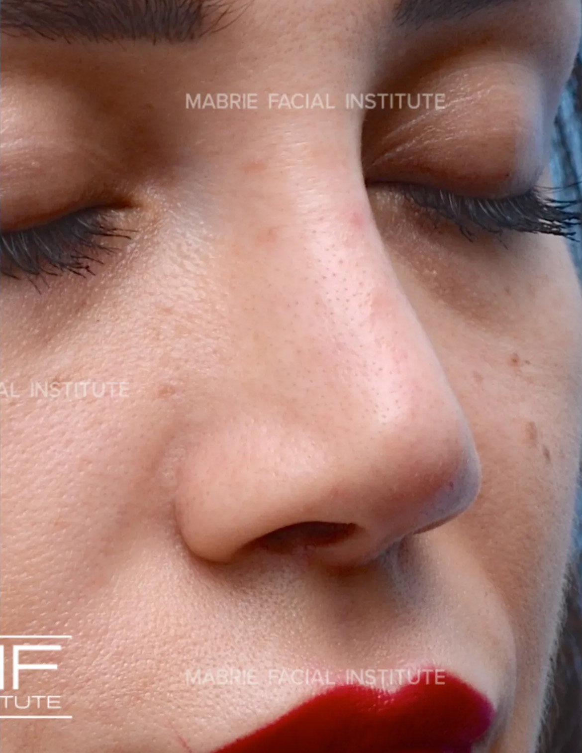 woman after nonsurgical rhinoplasty