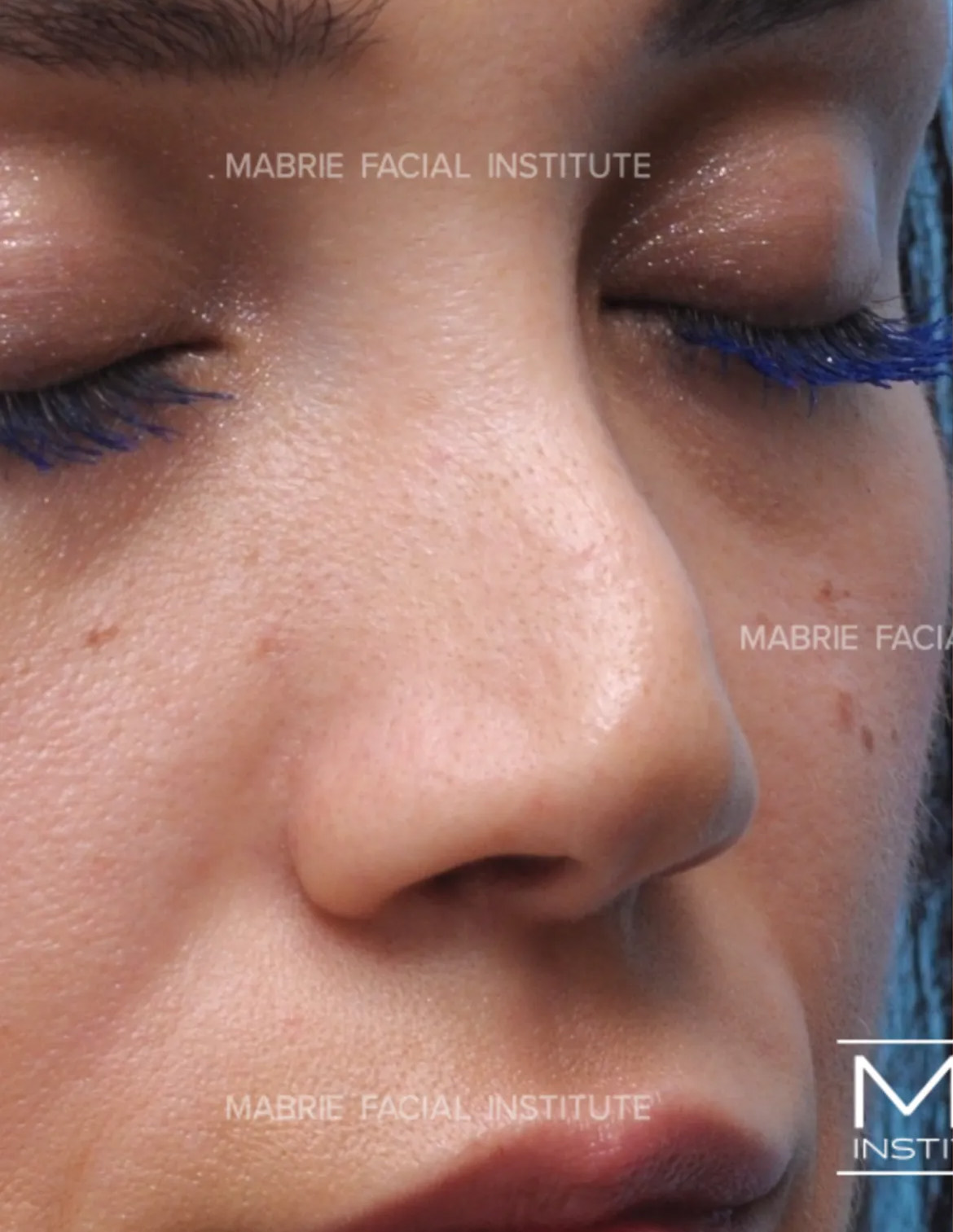 woman before nonsurgical rhinoplasty