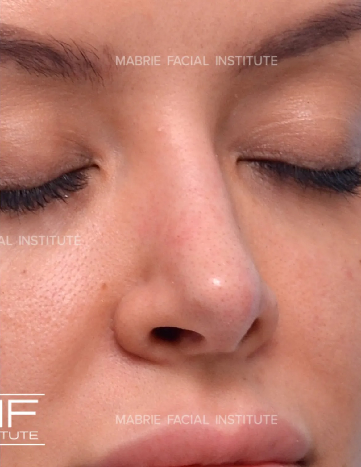 woman after nonsurgical rhinoplasty