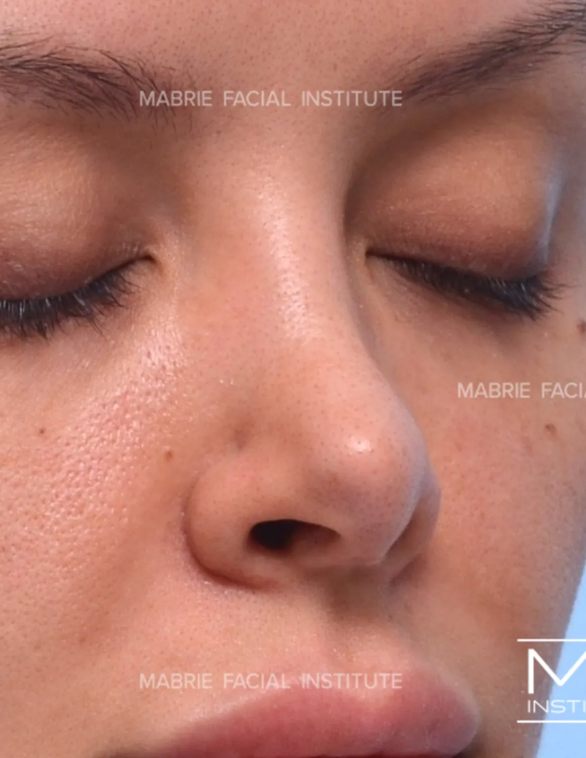 woman before nonsurgical rhinoplasty