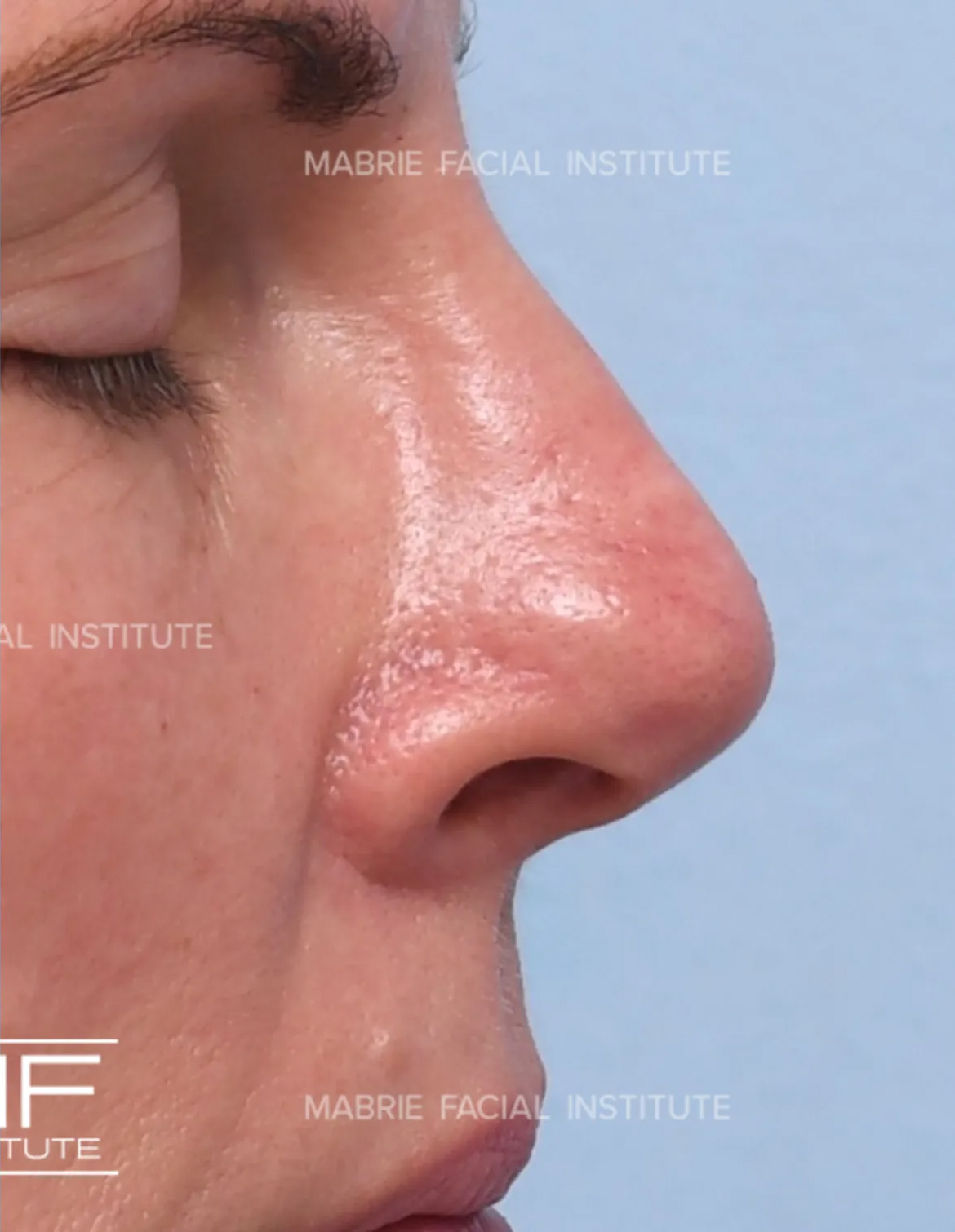 woman after nonsurgical rhinoplasty