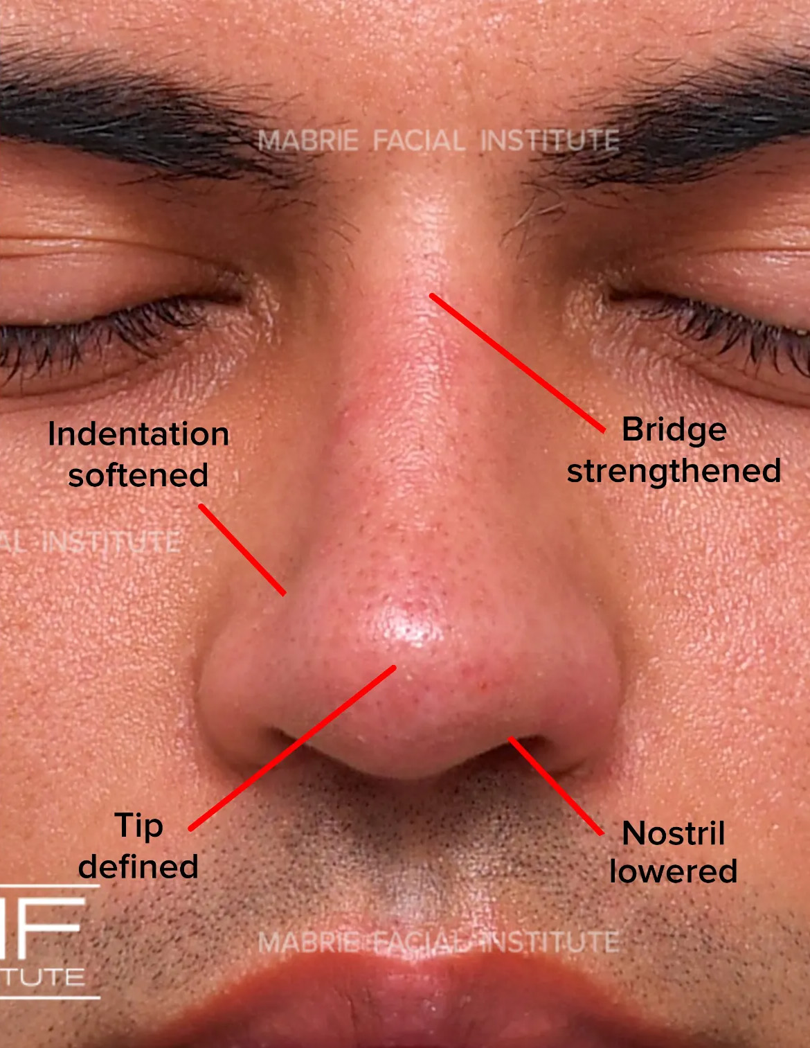 male after nonsurgical rhinoplasty