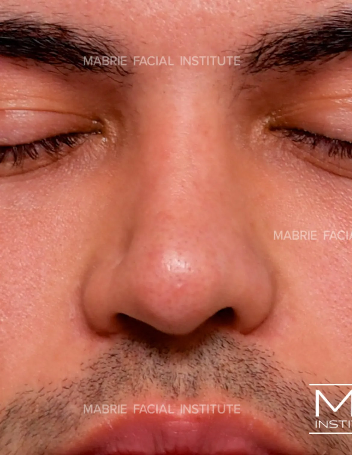 male before nonsurgical rhinoplasty