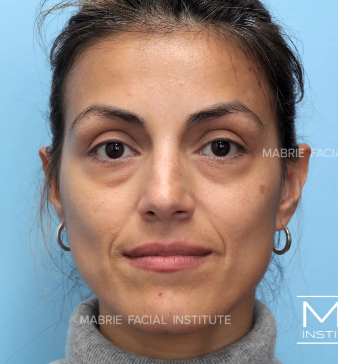 woman before under eye filler