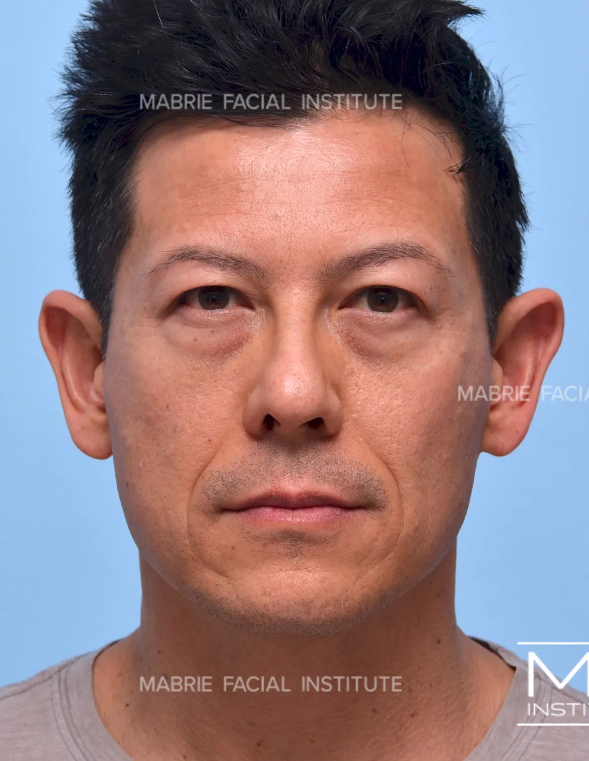 male before undereye filler
