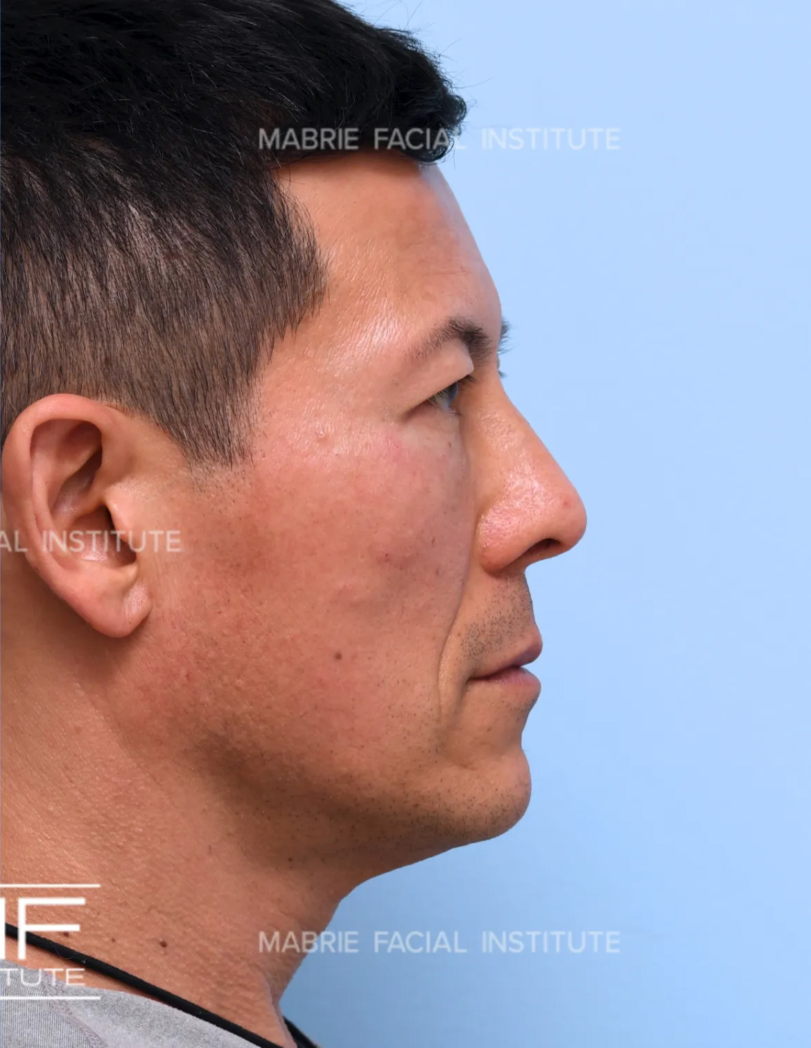 male after undereye filler