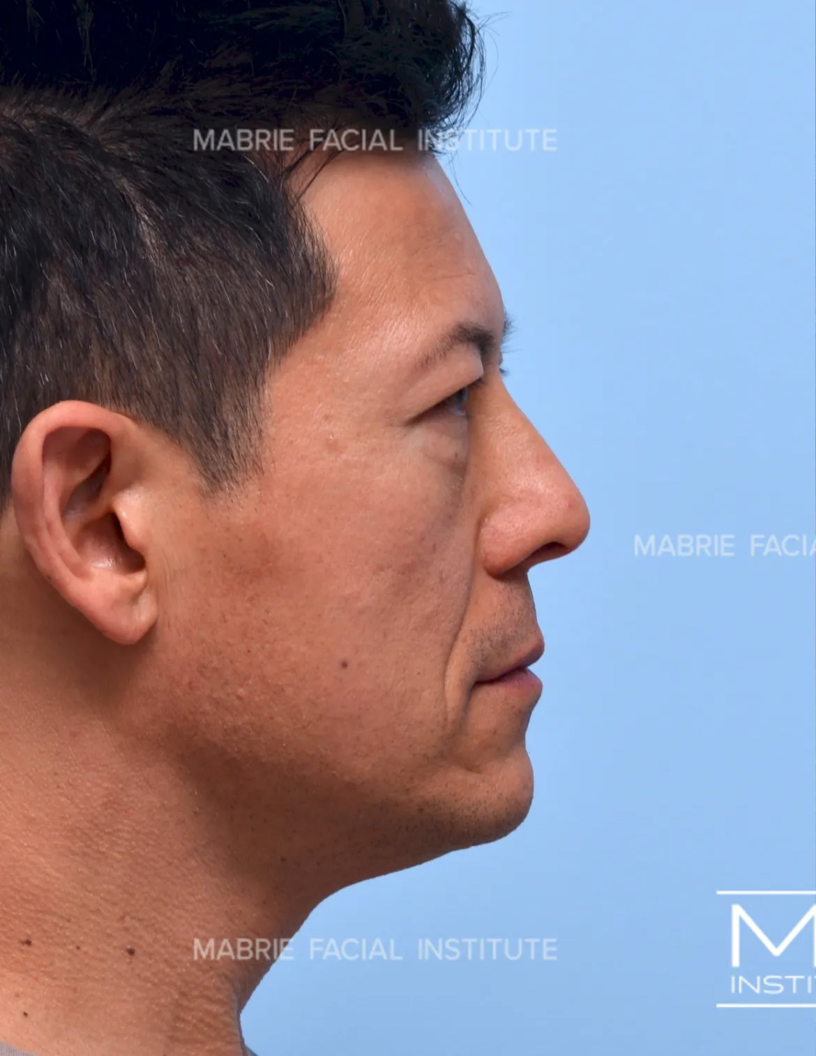 male before undereye filler