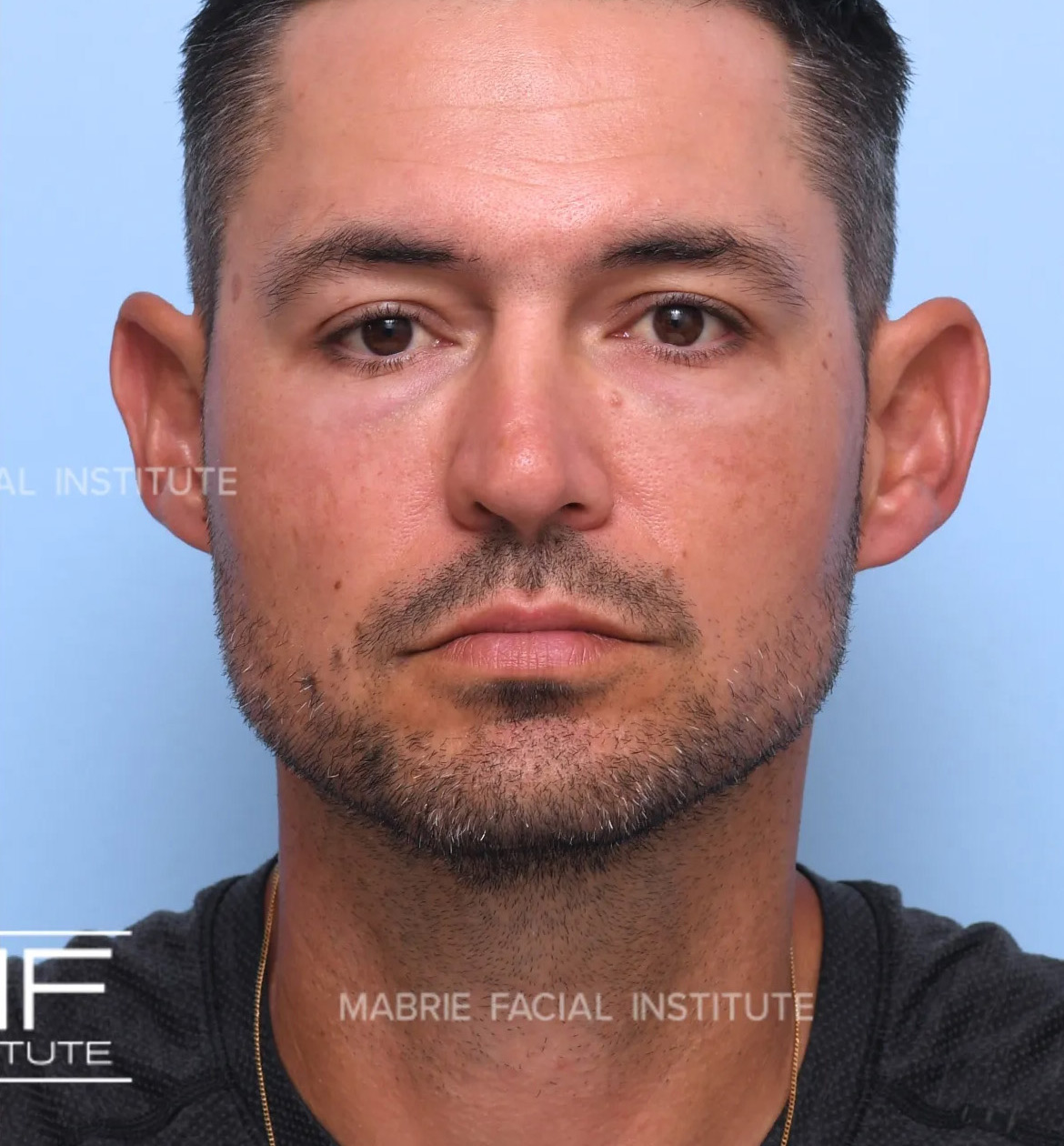 male after undereye filler