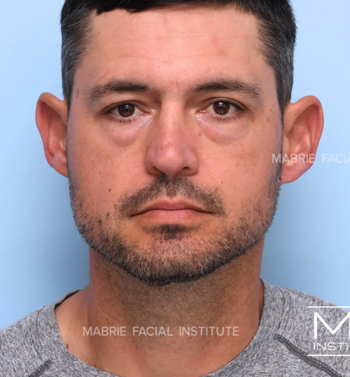 male before undereye filler