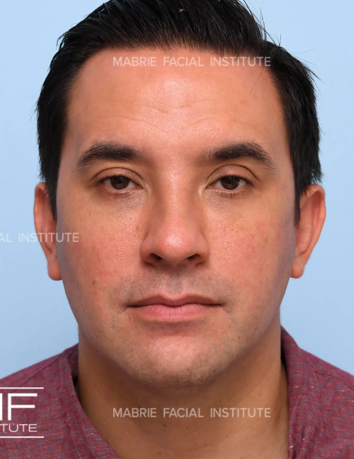 male after under eye fillers