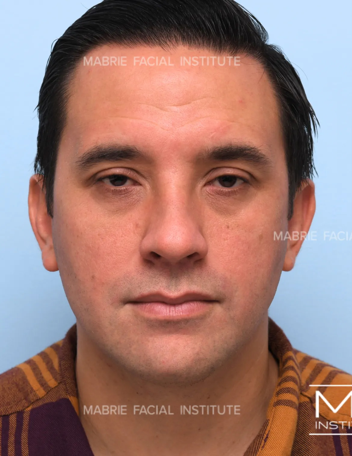 male before under eye fillers