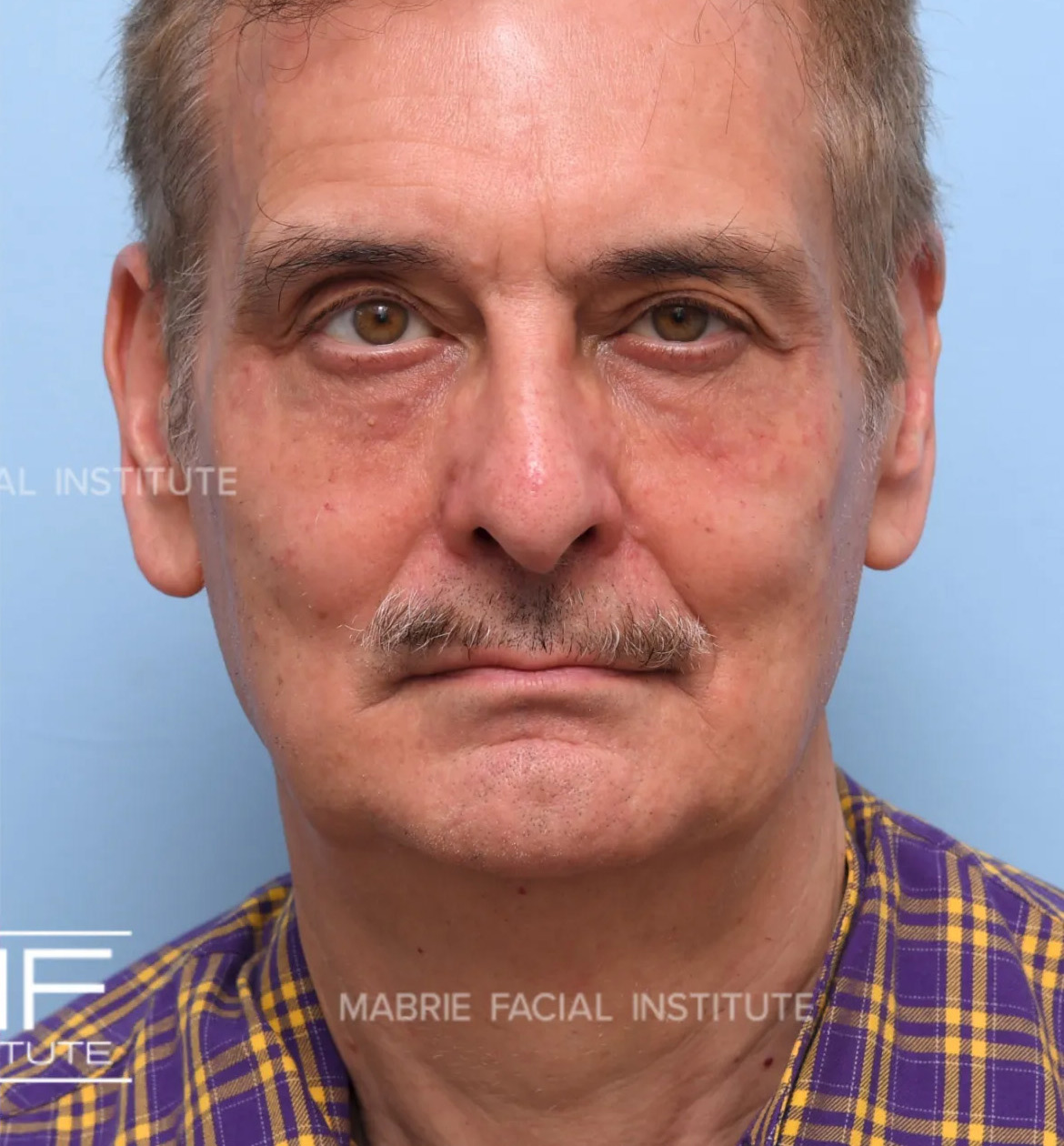 male after undereye filler