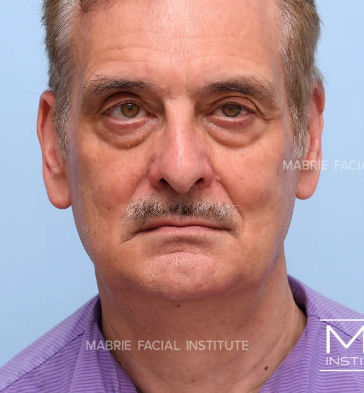 male before undereye filler