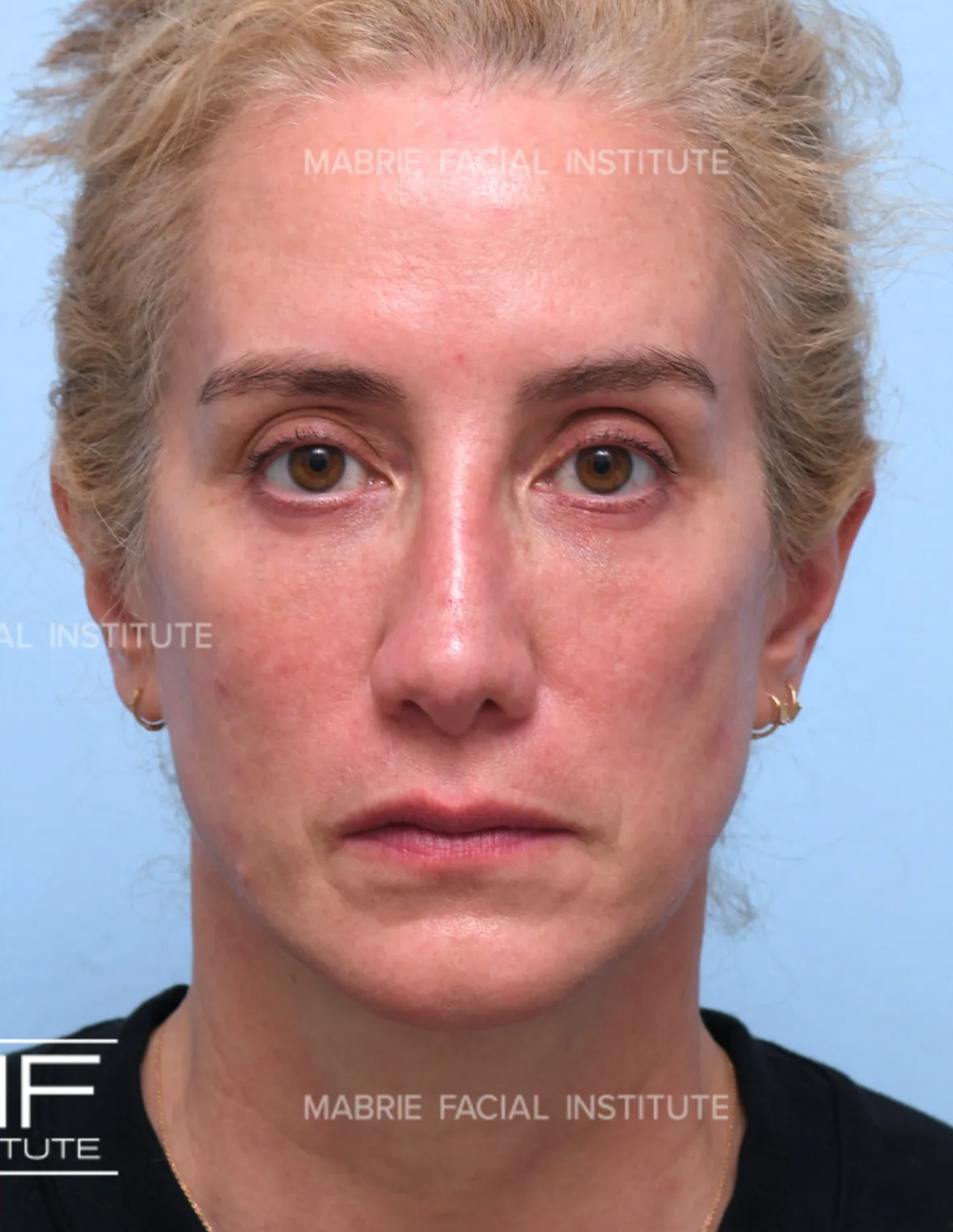 woman after under eye fillers
