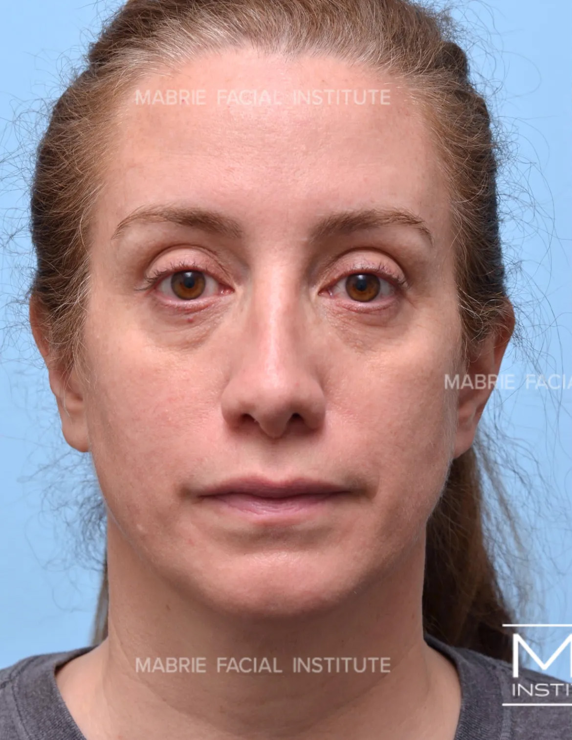 woman before under eye fillers
