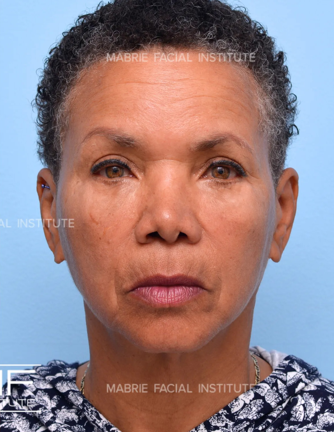 woman after under eye fillers