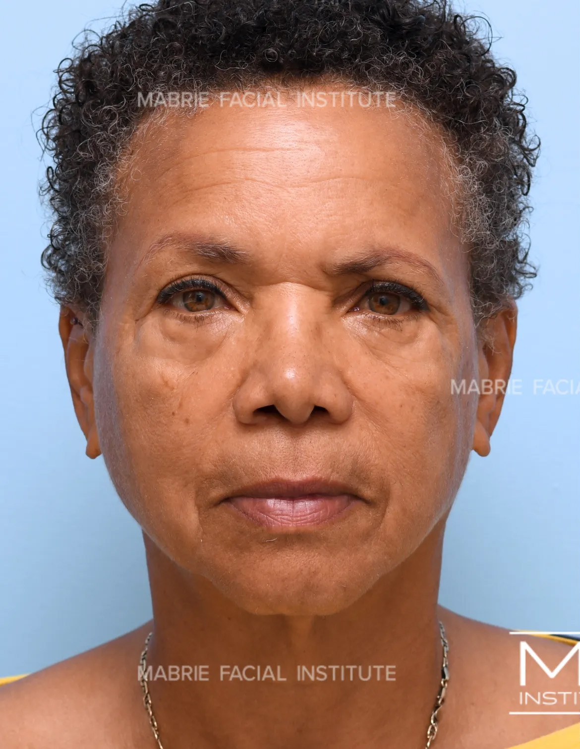 woman before under eye fillers
