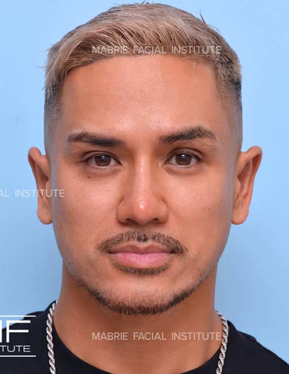 After complete facial rejuvenation
