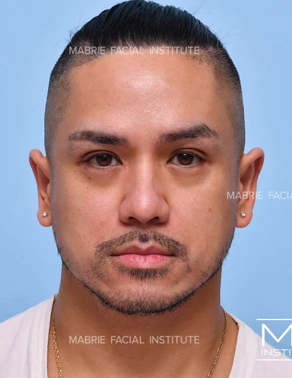 Before complete facial rejuvenation