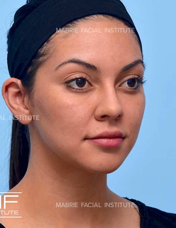 After complete facial rejuvenation