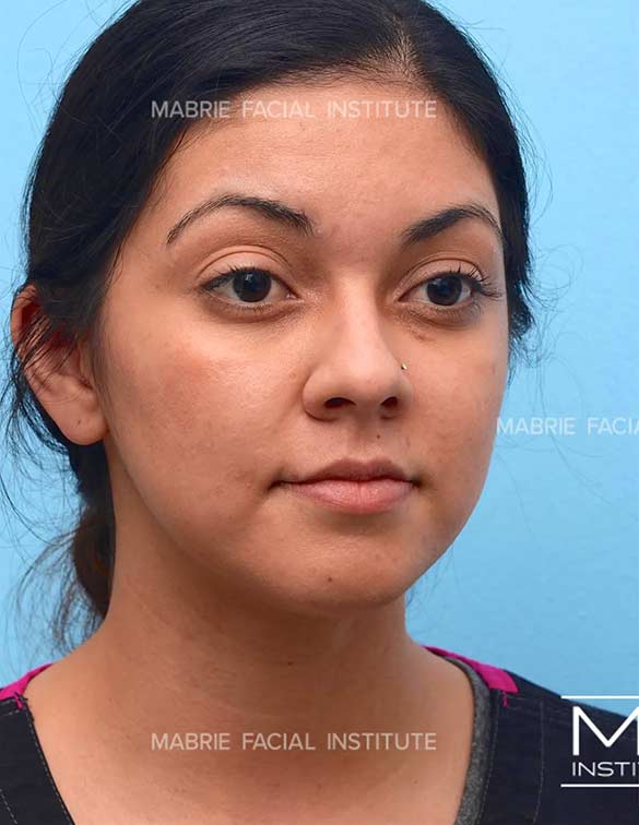 Before complete facial rejuvenation