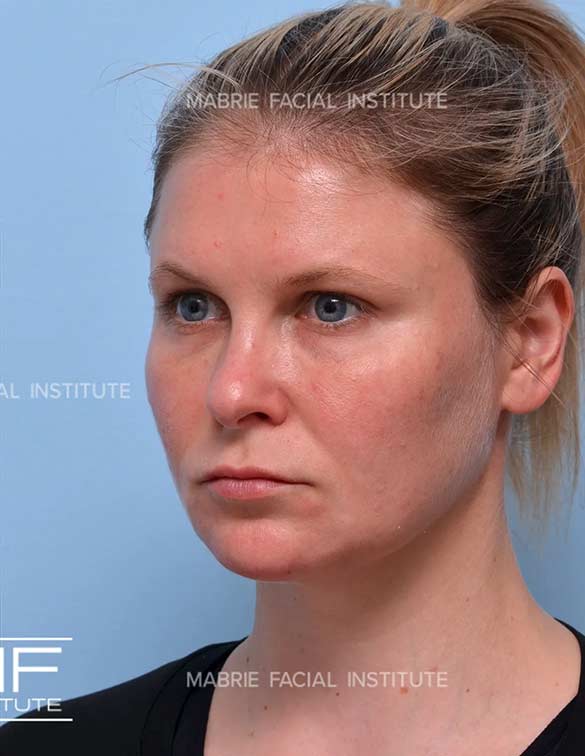 After complete facial rejuvenation