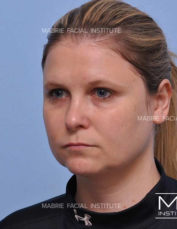 Before complete facial rejuvenation