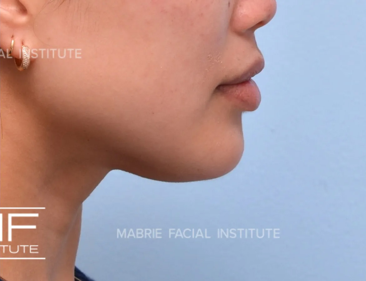 Woman after chin dimpling treatment