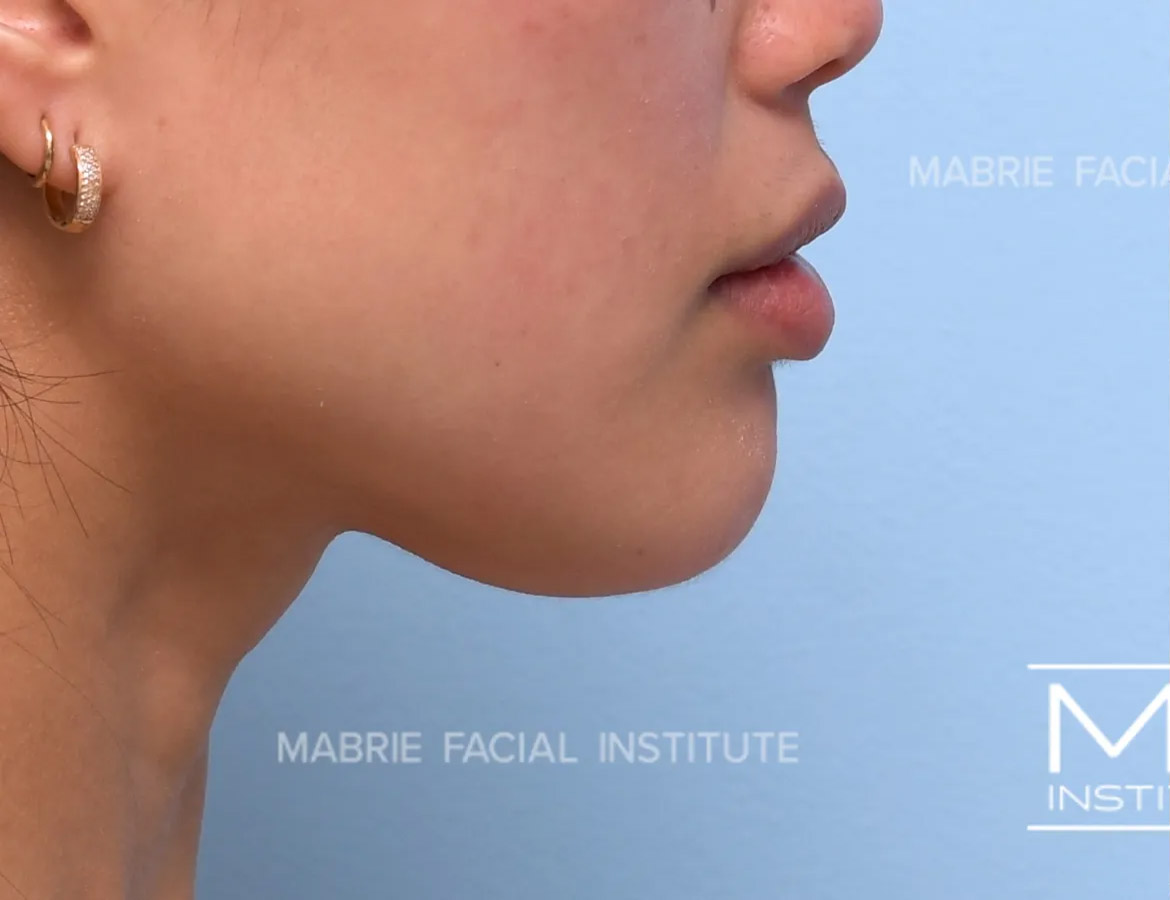 Woman before chin dimpling treatment
