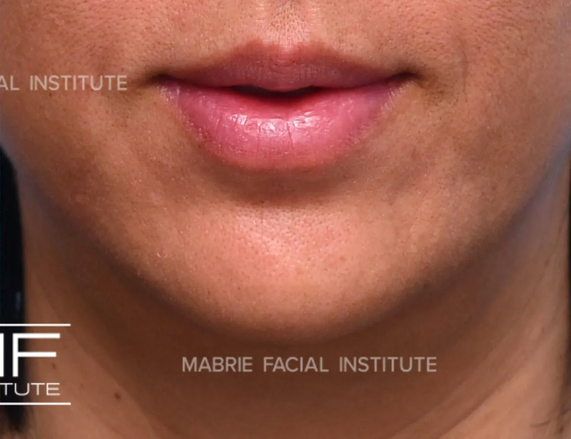 Woman after chin dimpling treatment