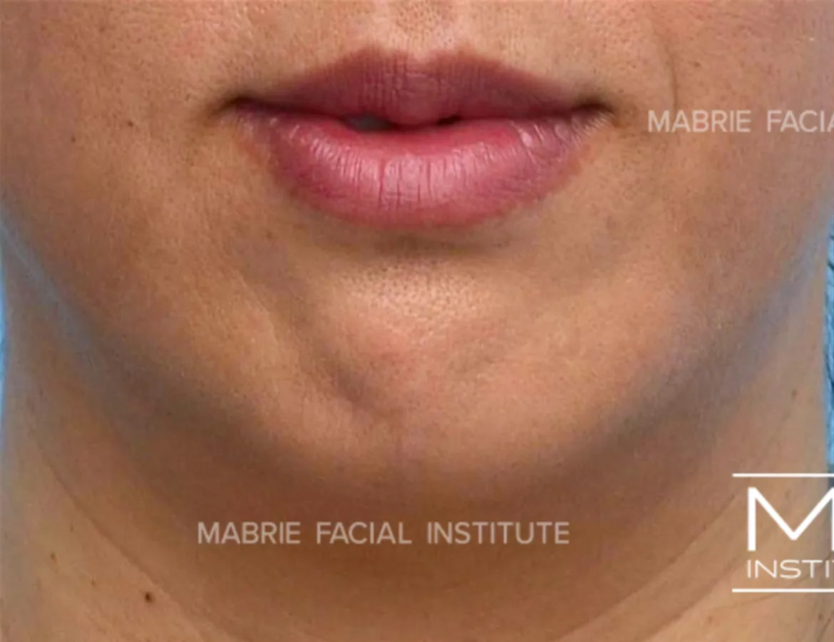 Woman before chin dimpling treatment