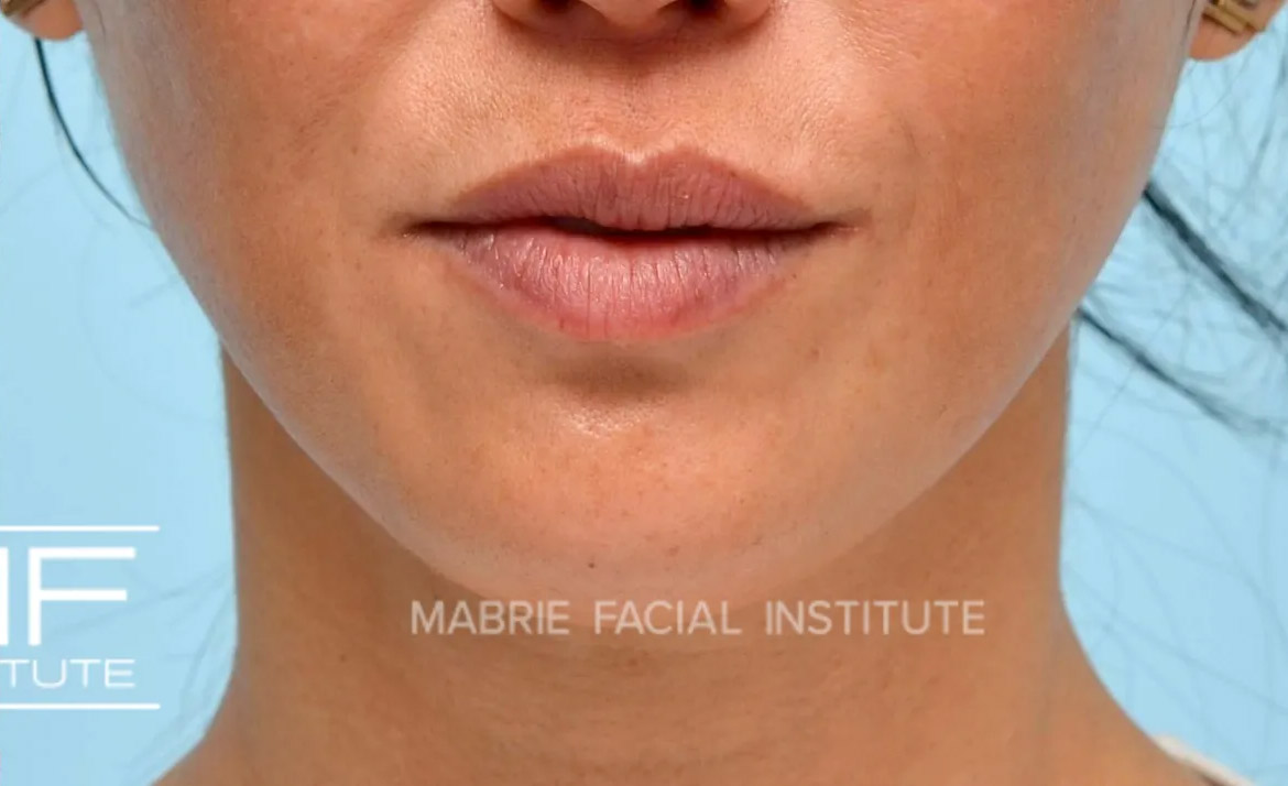 Woman after chin dimpling treatment
