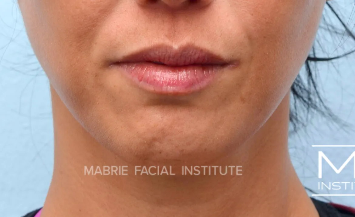 Woman before chin dimpling treatment