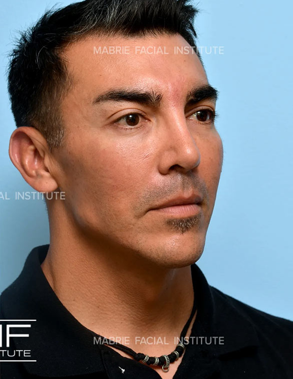 After complete facial rejuvenation