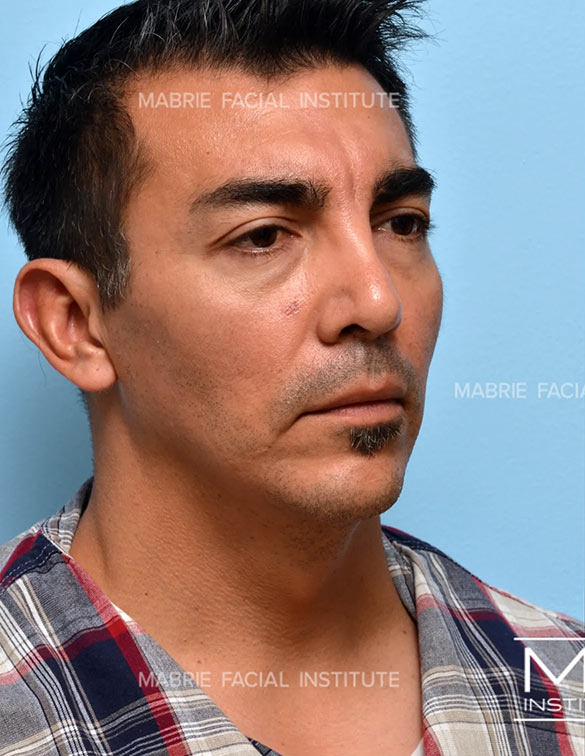 Before complete facial rejuvenation
